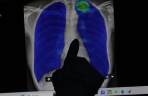 Masih Banyak Tantangan dalam Penanggulangan Tuberkulosis