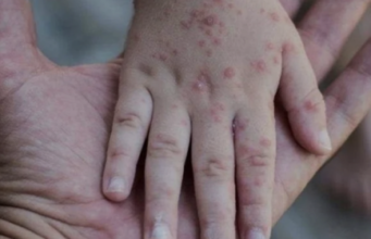 Ancaman Flu Singapura Meningkat, Vaksin Belum Tersedia