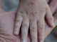 Ancaman Flu Singapura Meningkat, Vaksin Belum Tersedia