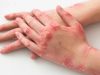 Ini Karakteristik Ruam Klinis yang Kerap Dijumpai pada Penderita Mpox