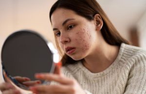 8 Cara Menghilangkan Flek Hitam Bekas Jerawat